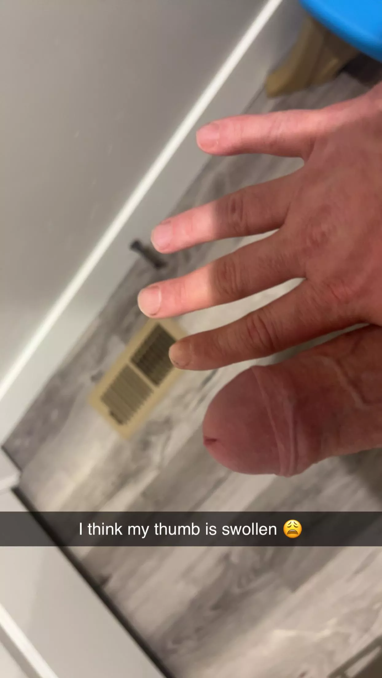 Swollen thumb 😩