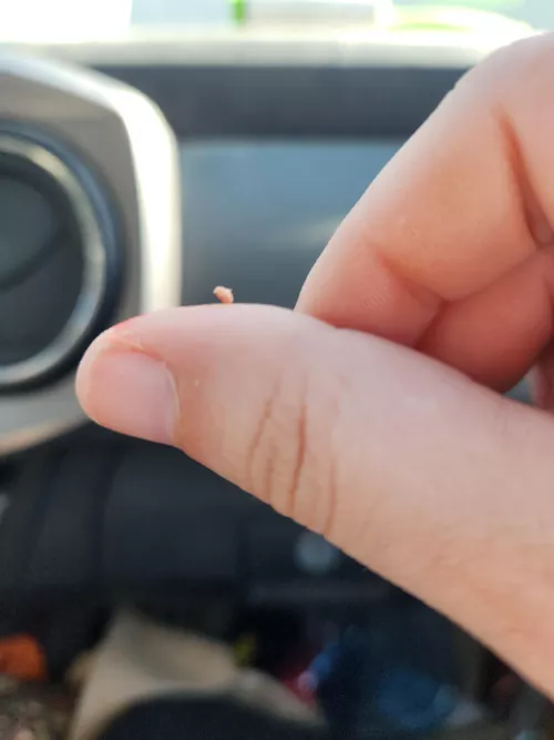 Finay defeated my month long pimple