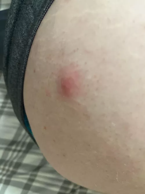 These keep appearing on my thigh, and I try to remove them, but they keep appearing. What are these? (NSFW for pic being taken near butt.)