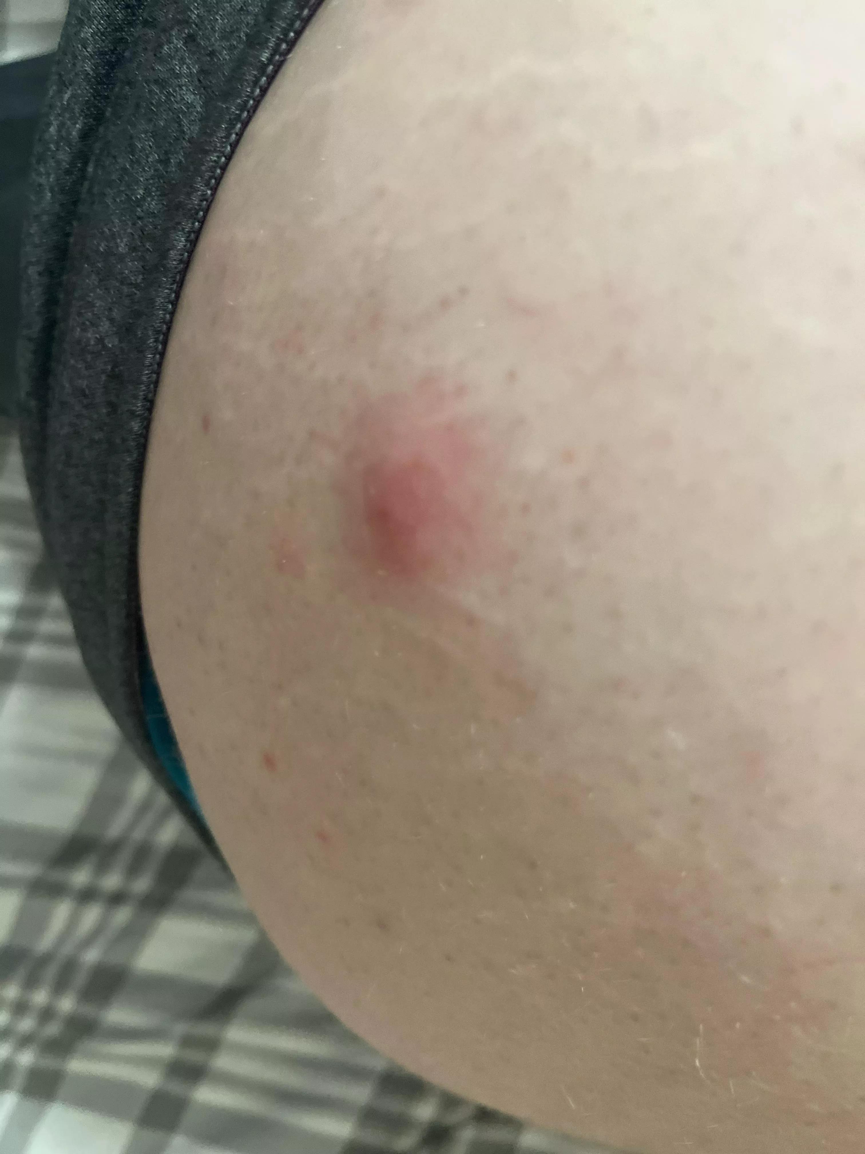 These keep appearing on my thigh, and I try to remove them, but they keep appearing. What are these? (NSFW for pic being taken near butt.)