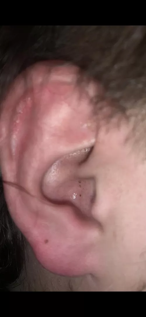 Blackheads in my boyfriend’s ear, he won’t let me pop them!!!