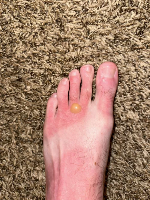 PSA: wear your sunscreen