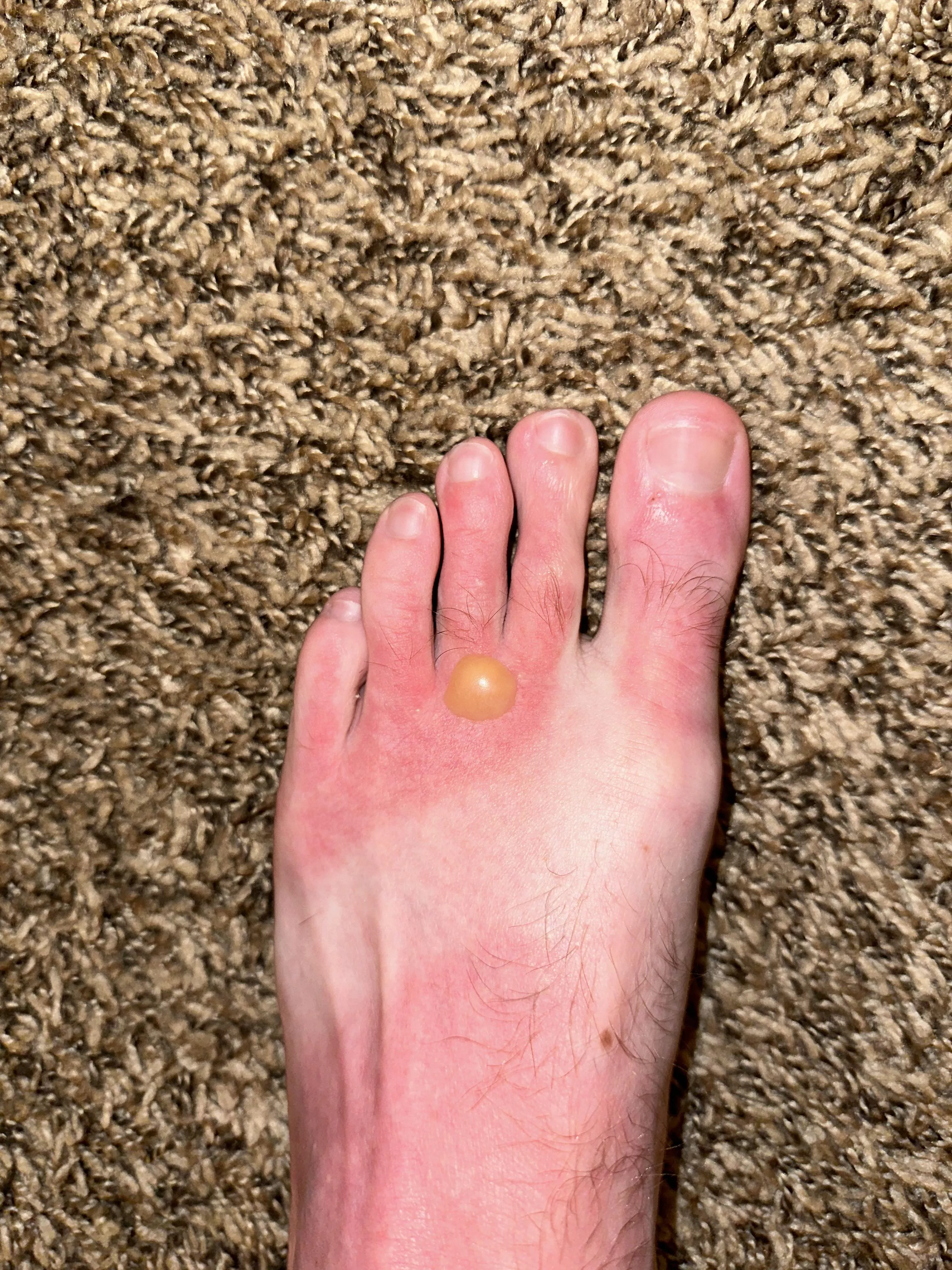 PSA: wear your sunscreen