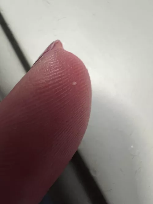 milia from forehead finally cut it out!