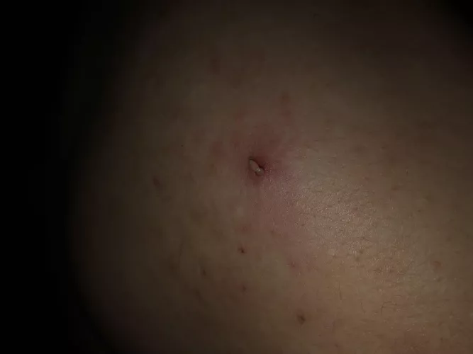 Brutal one on my shoulder 😳