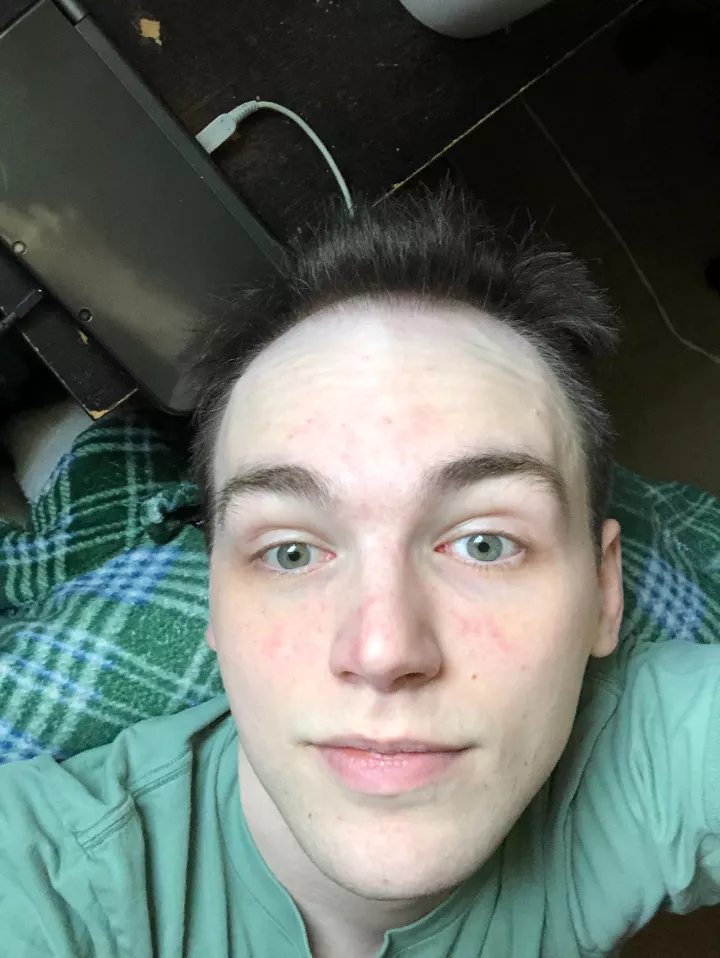 Feels so great after a shower feeling abit less good today though