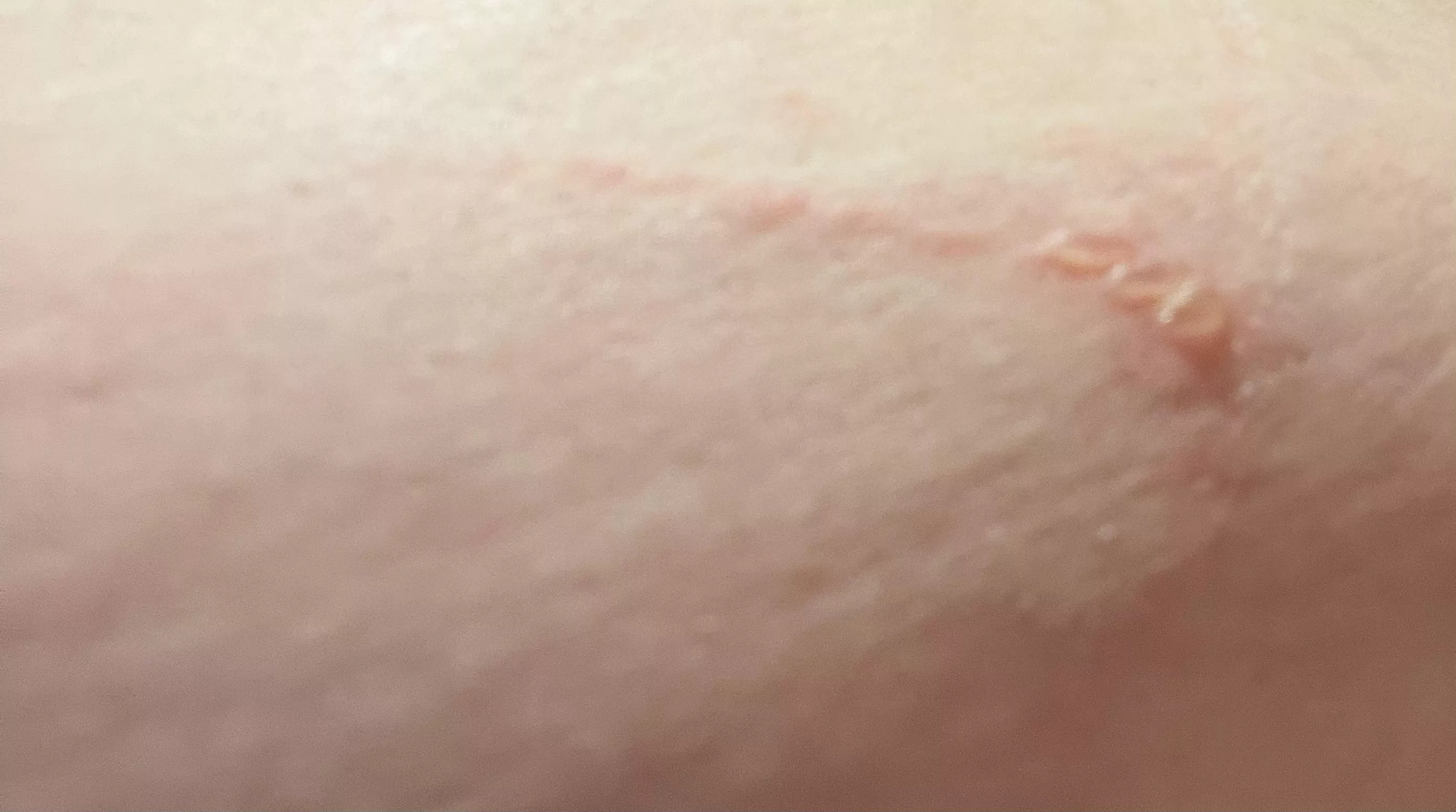 Forbidden pops from KT tape.