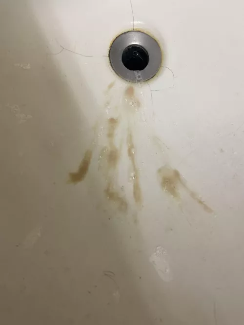 Aftermath of a tonsillar abscess. Was spitting out pus for 20 minutes