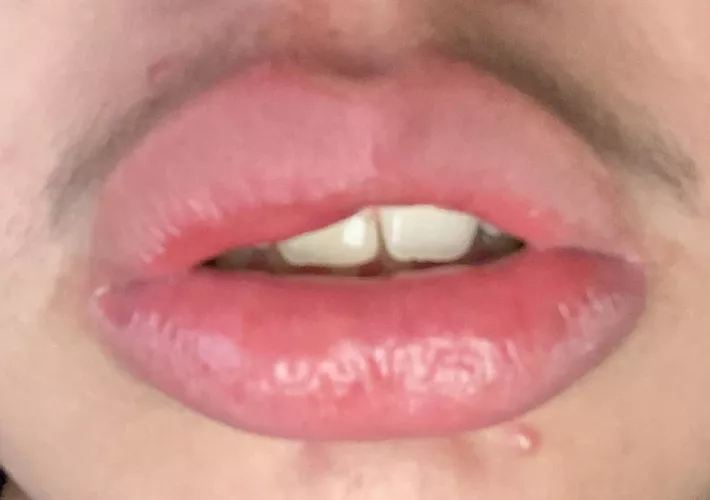 Idk if this is the place to post this but my lip swells like this at the top right from time to time. It’s generally not very painful but it’s uncomfortable. Normally takes a day or two to go down.
