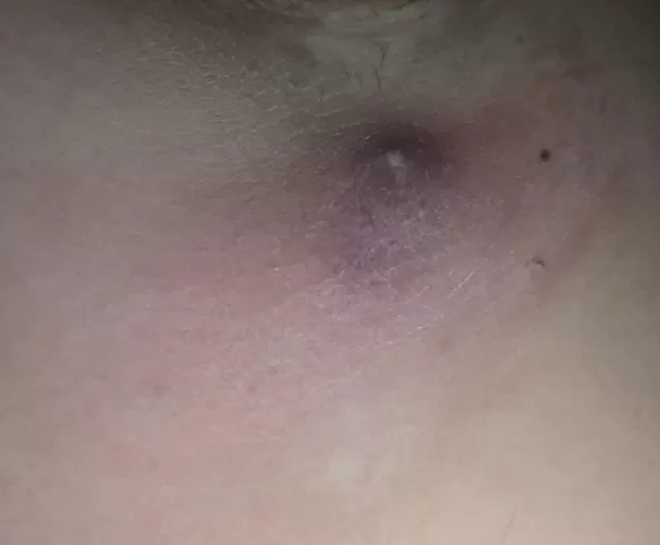 Cyst in armpit ready to burst