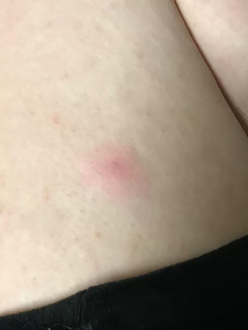 If any group can tell me what the hell this is on my leg it’s you guys