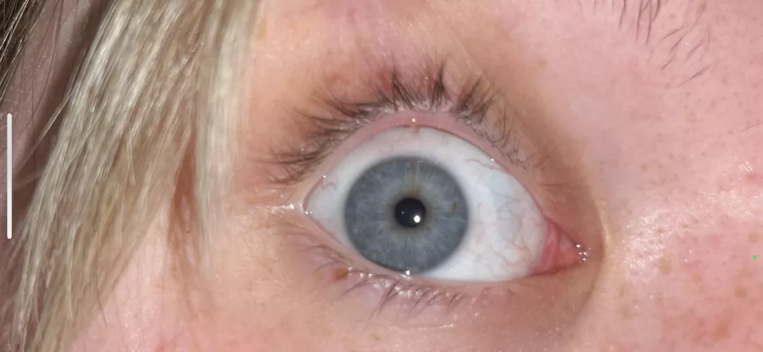Forbidden pop on my eyelid.