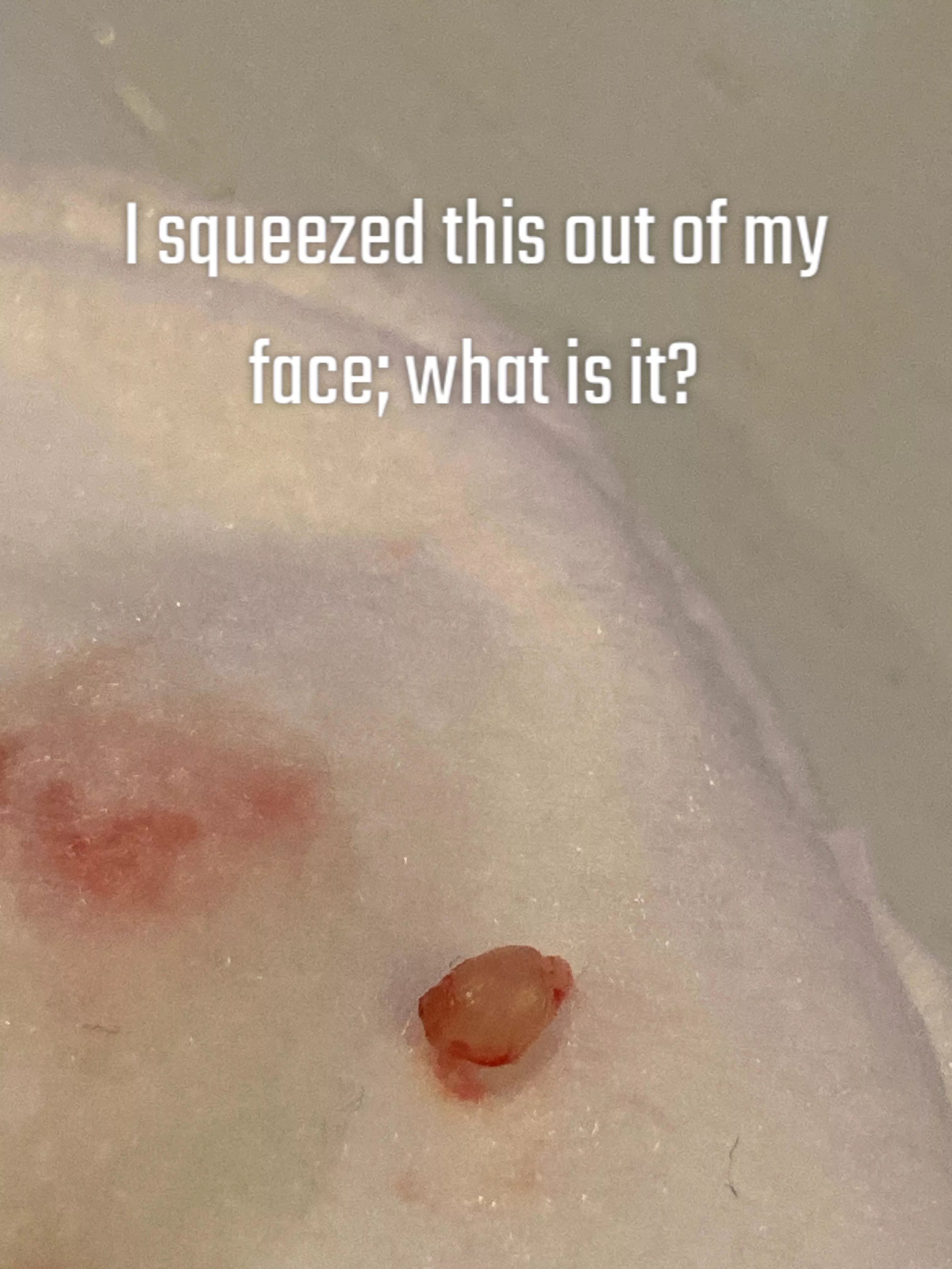 I squeezed this out of my face, what is it?