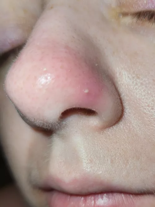 I'm not supposed to pop this, but it's almost too tempting. It also is super painful.