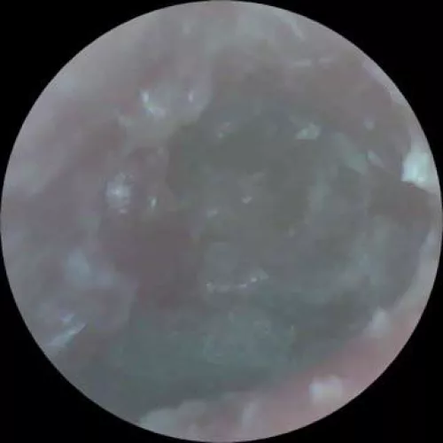 Ear Infection. Should I touch it and clean it?