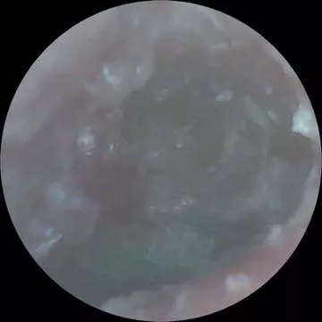 Ear Infection. Should I touch it and clean it?