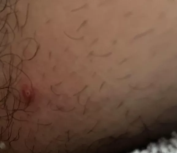 what’s this little guy? wont seem to pop, around back of mid thigh.