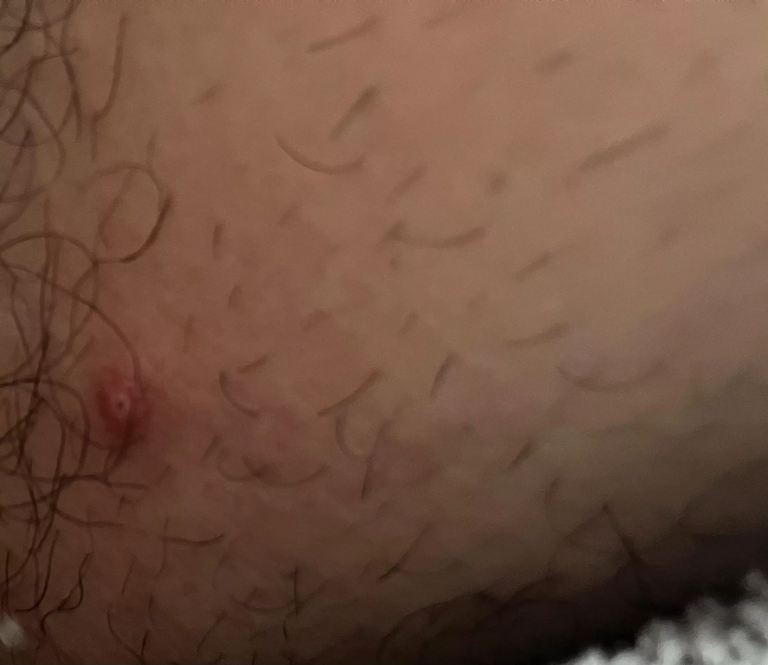 what’s this little guy? wont seem to pop, around back of mid thigh.
