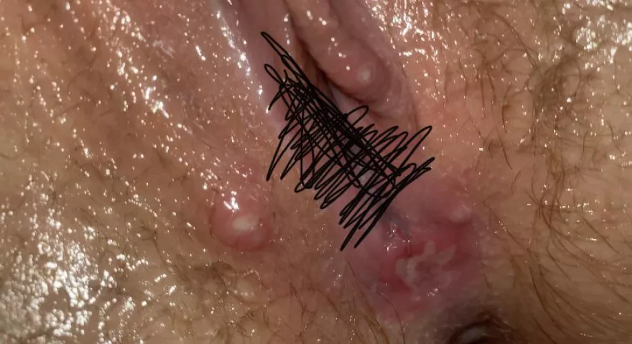 cyst or pimple? if so, i have the urge to pop them, very painful to touch though. NSFW
