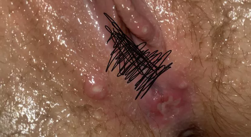 cyst or pimple? if so, i have the urge to pop them, very painful to touch though. NSFW