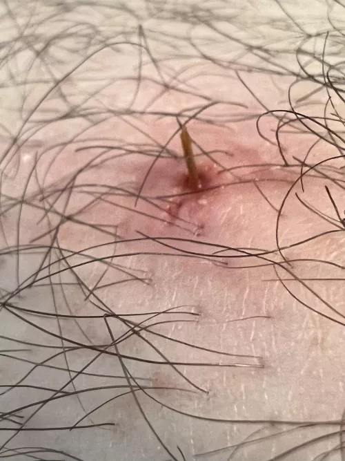 Pushed out another leg splinter today. Was very painful for a few days.