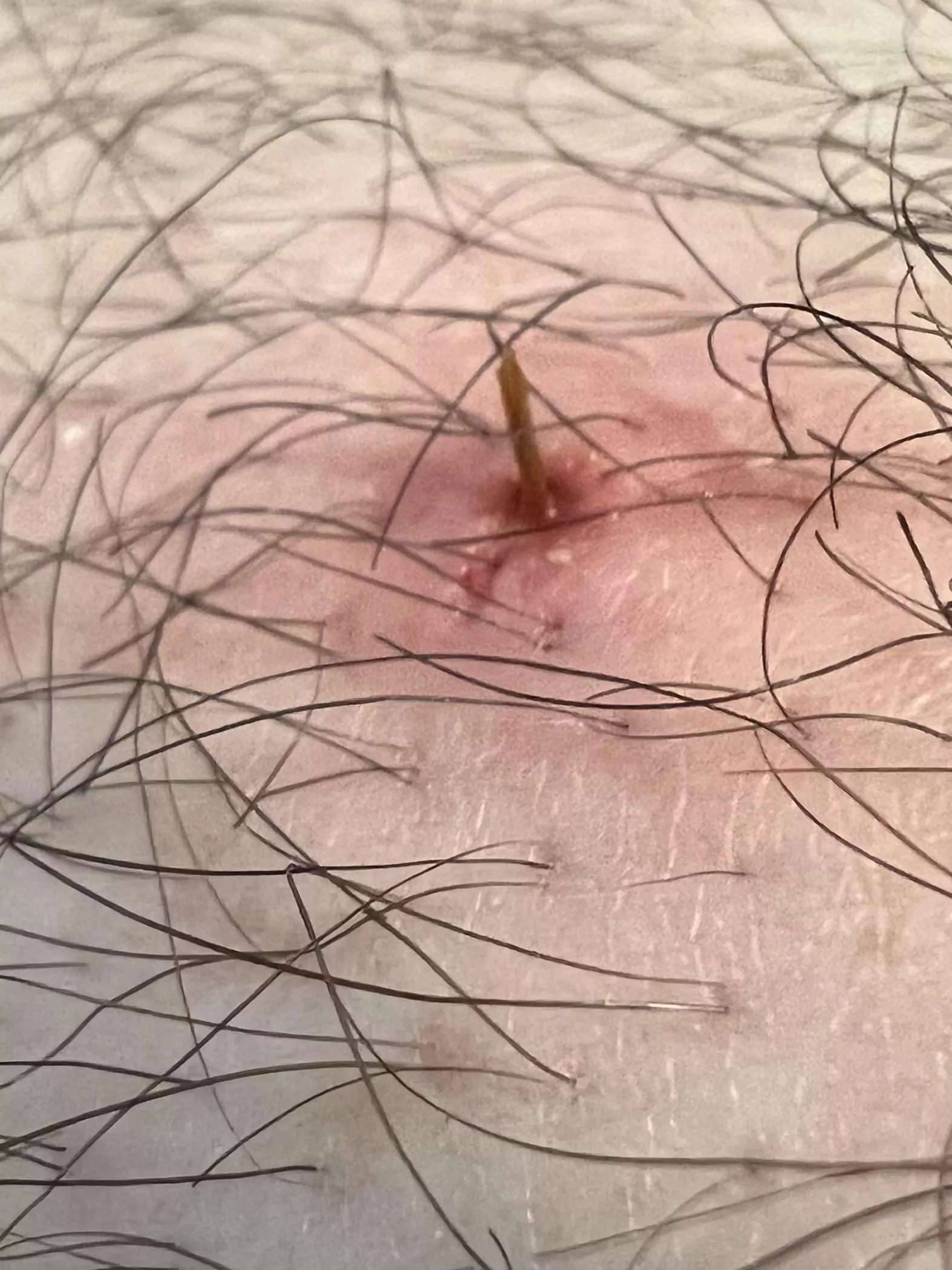 Pushed out another leg splinter today. Was very painful for a few days.