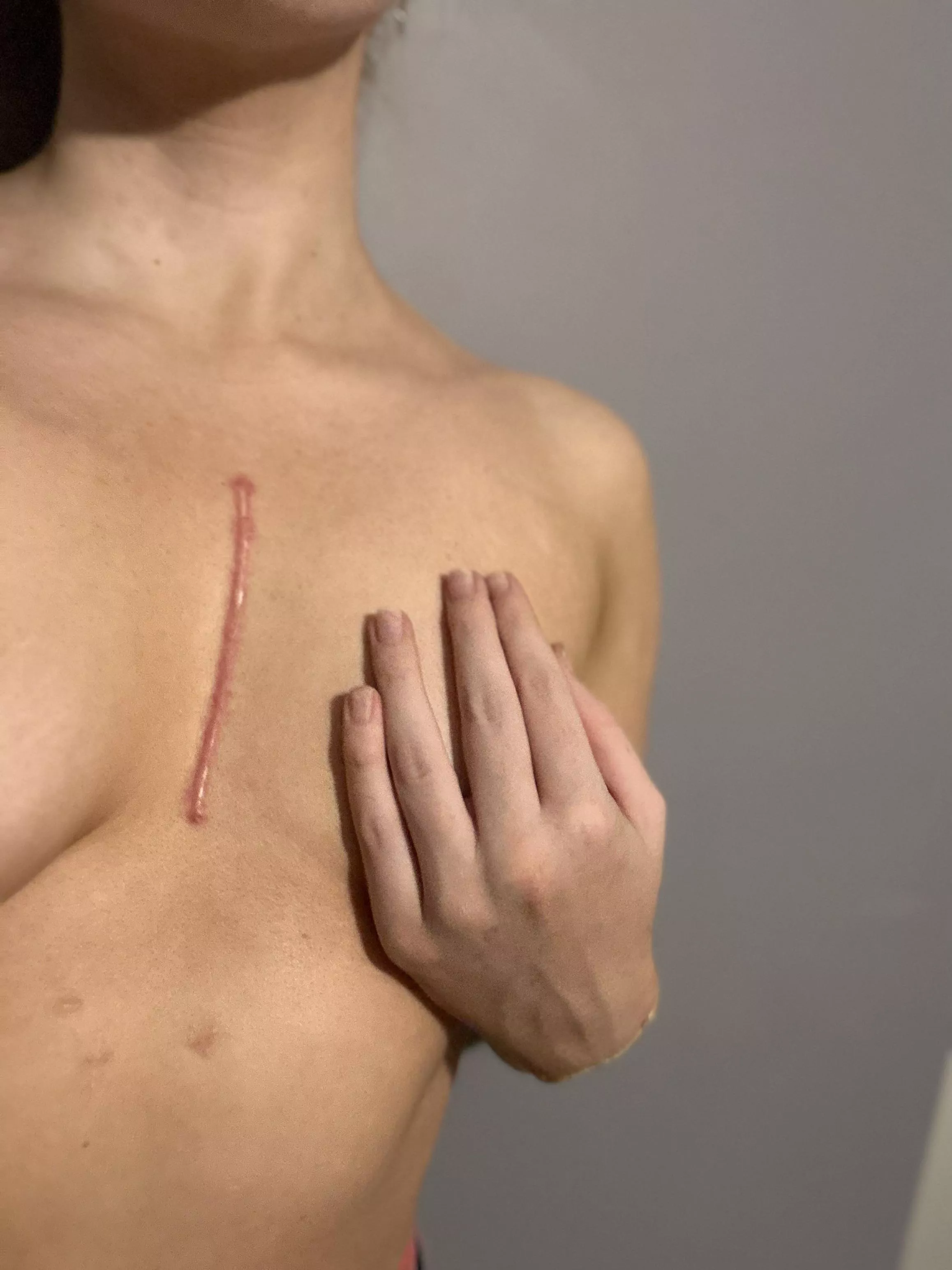 Trying to get more comfortable with my scar. 28, 70kg, 172cm