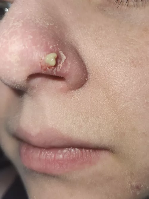 Update on my little nose friend. It was Staph. It also popped on it's own when I blew my nose 😭