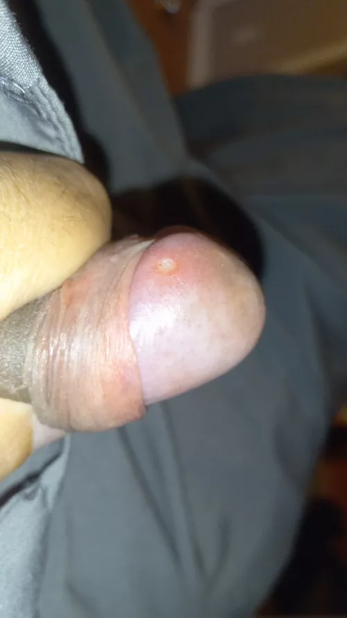 Can someone please help me figure out what this is haven't been sexually active in a couple months but have been maturbating alot an my hygiene cleaning up after hasn't been that good either idk if it's a std or what can someone please help