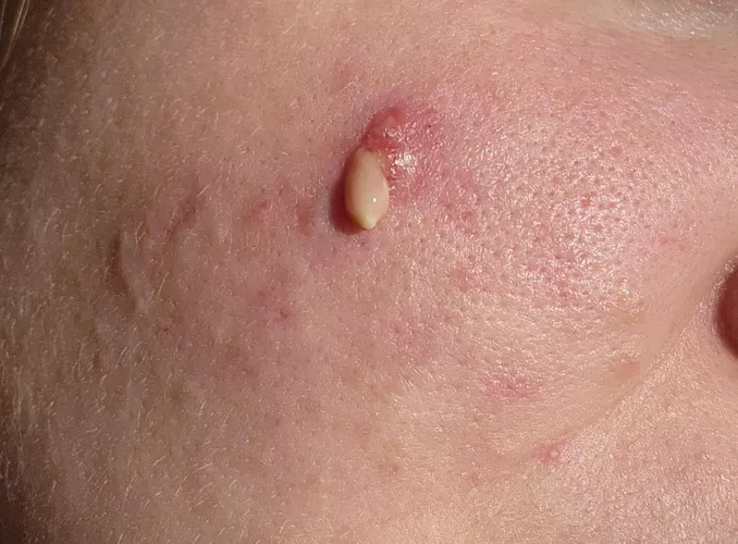 I've been fighting this fucker for over a year. With the help of a dermatologist (this is the third time it's popped,) I think it may finally be passing.