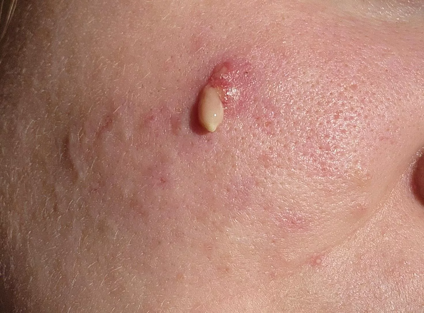 I've been fighting this fucker for over a year. With the help of a dermatologist (this is the third time it's popped,) I think it may finally be passing.