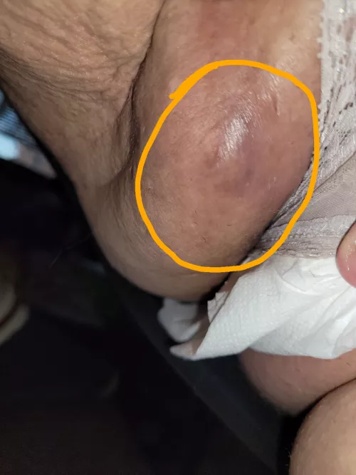 Large strep b boil/abcess on vagina. It has ruptured on its own and I am on medicine to get rid of the infection. It was caused by a high blood sugar for a prolonged period of time.