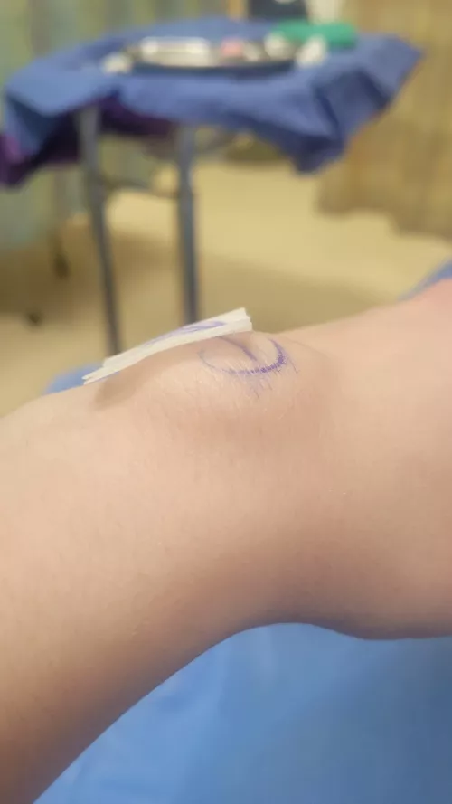 The surgeon numbed my wrist for a cyst removal and the freezing created a huge bubble under my skin.