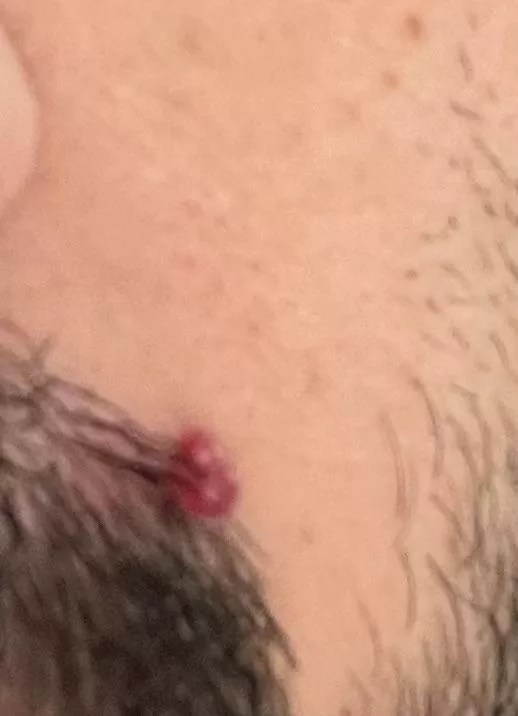 I think I have pyogenic granuloma. Is there anyway to treat this without having to see dermatologist?