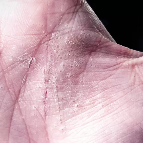 Stress related dyshidrosis is my webMD guess