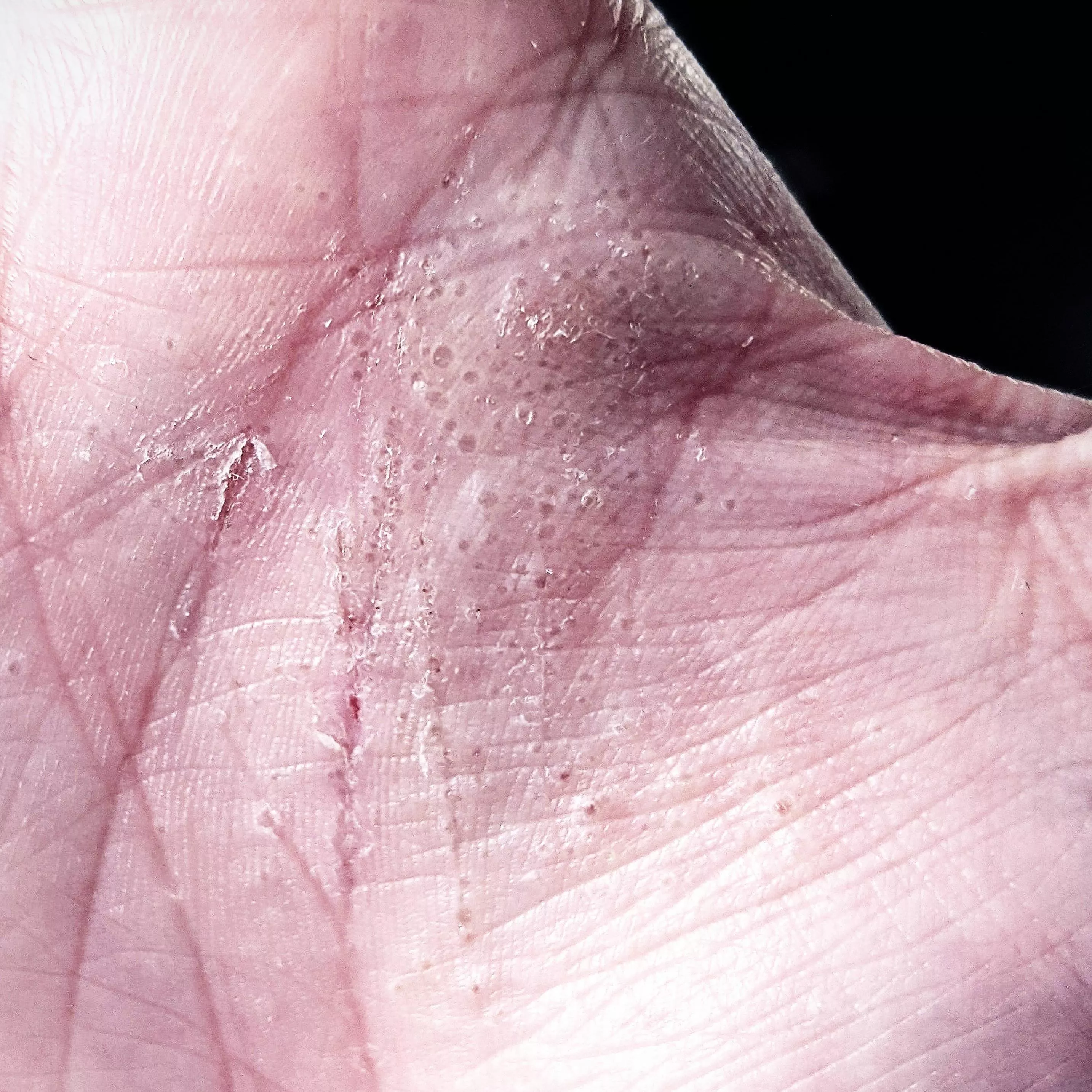 Stress related dyshidrosis is my webMD guess