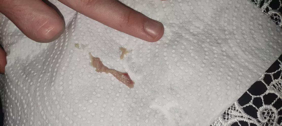 What even is this thing that came out of my nose (41° fever)