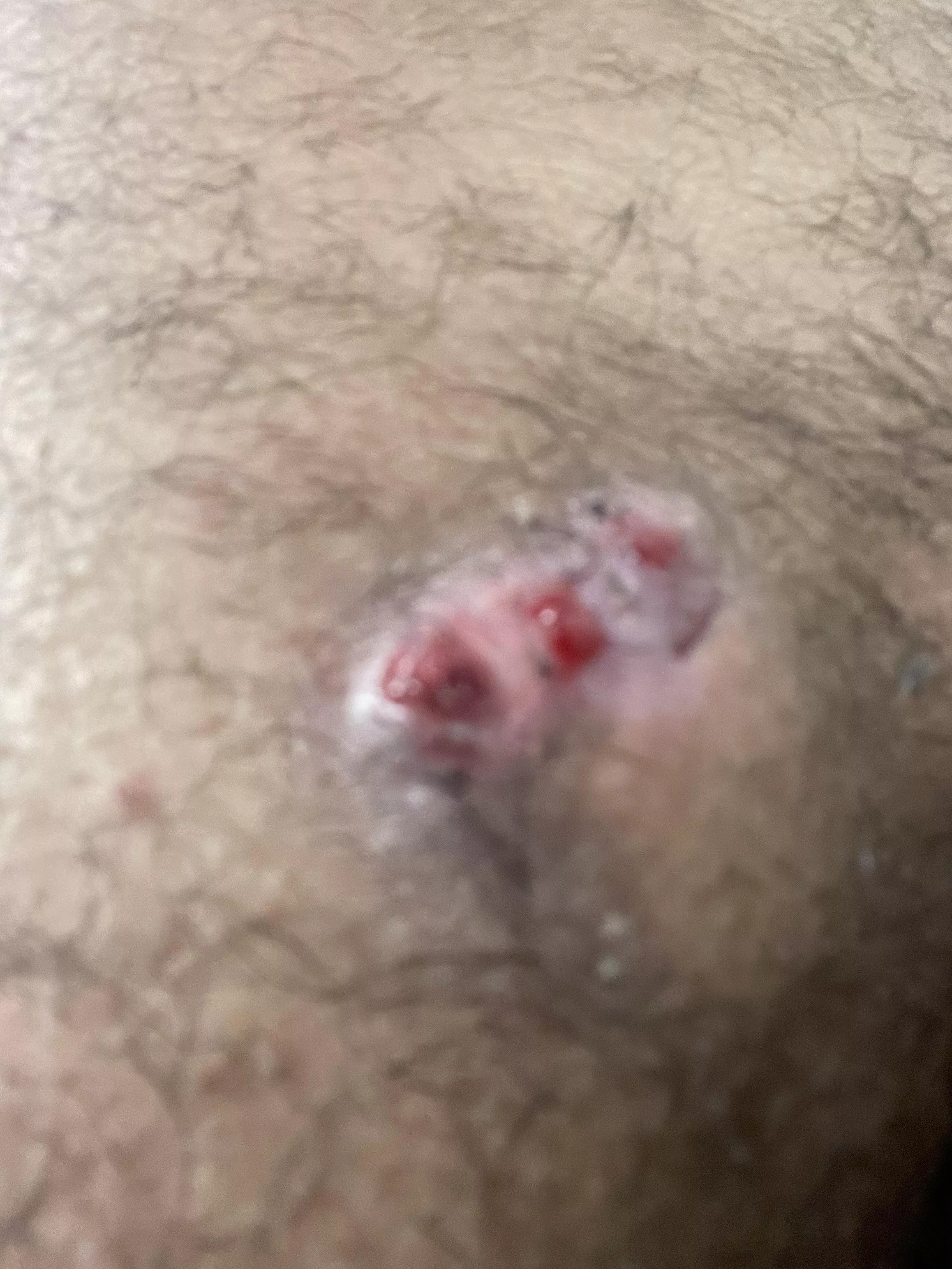 Sebaceous cyst on my ass