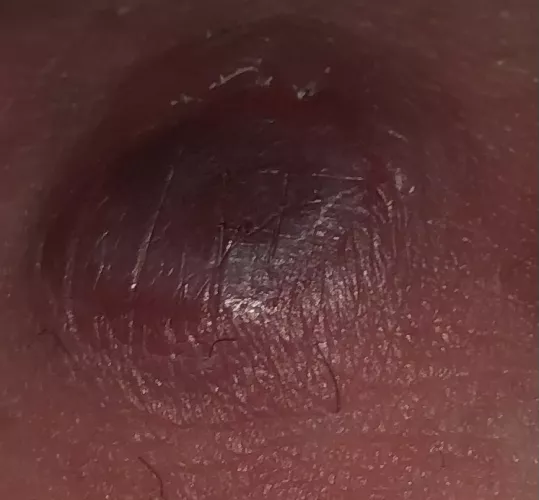 What is this on my thigh?