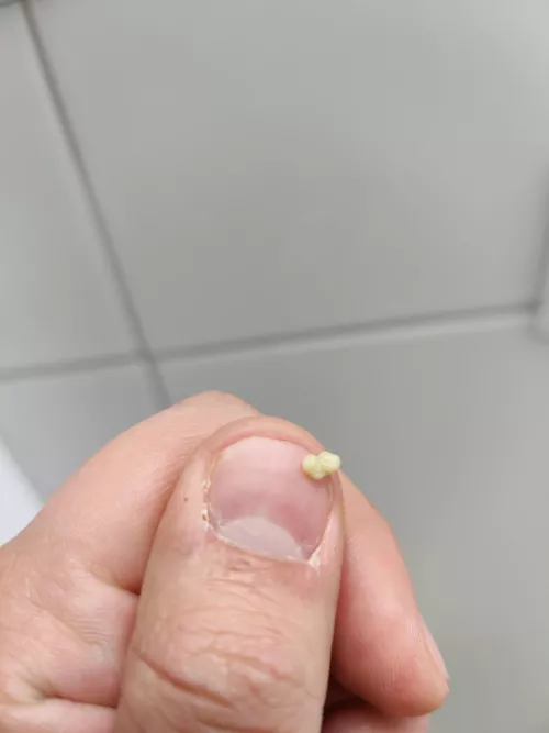 Random big tonsil stone