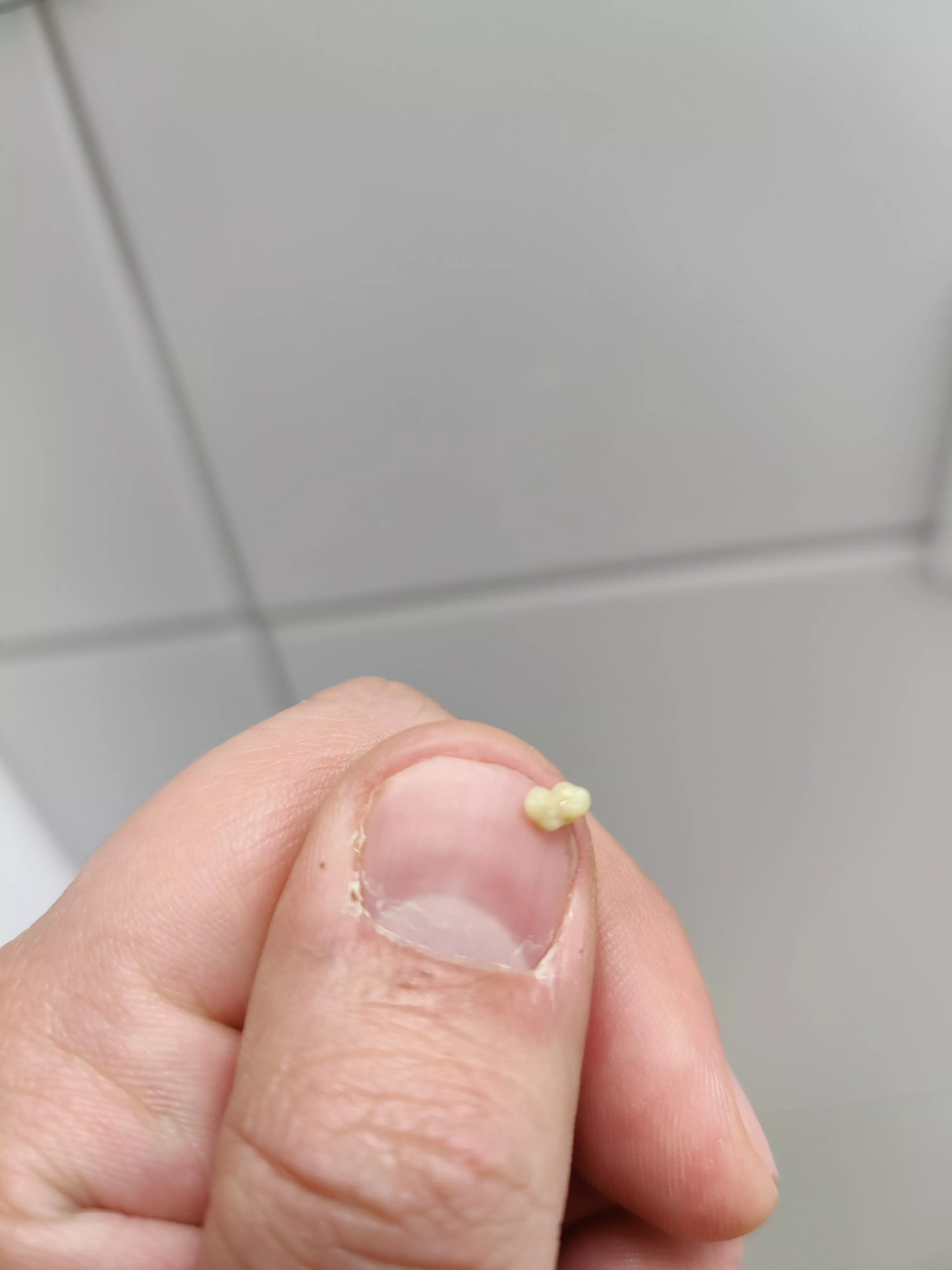 Random big tonsil stone