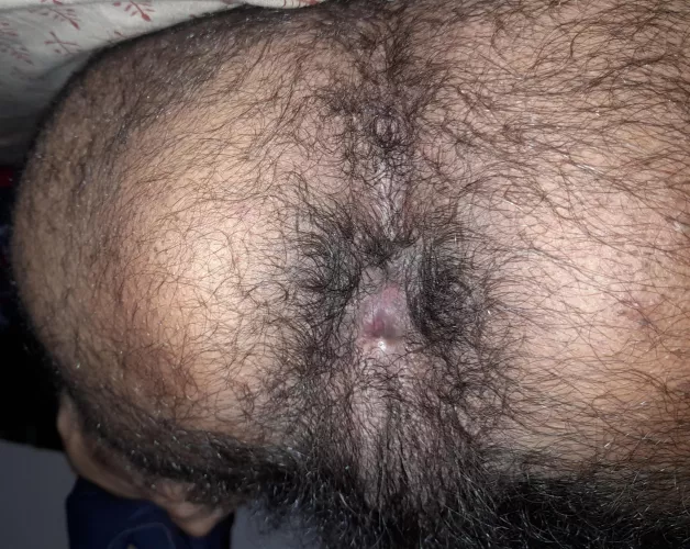 My hairy