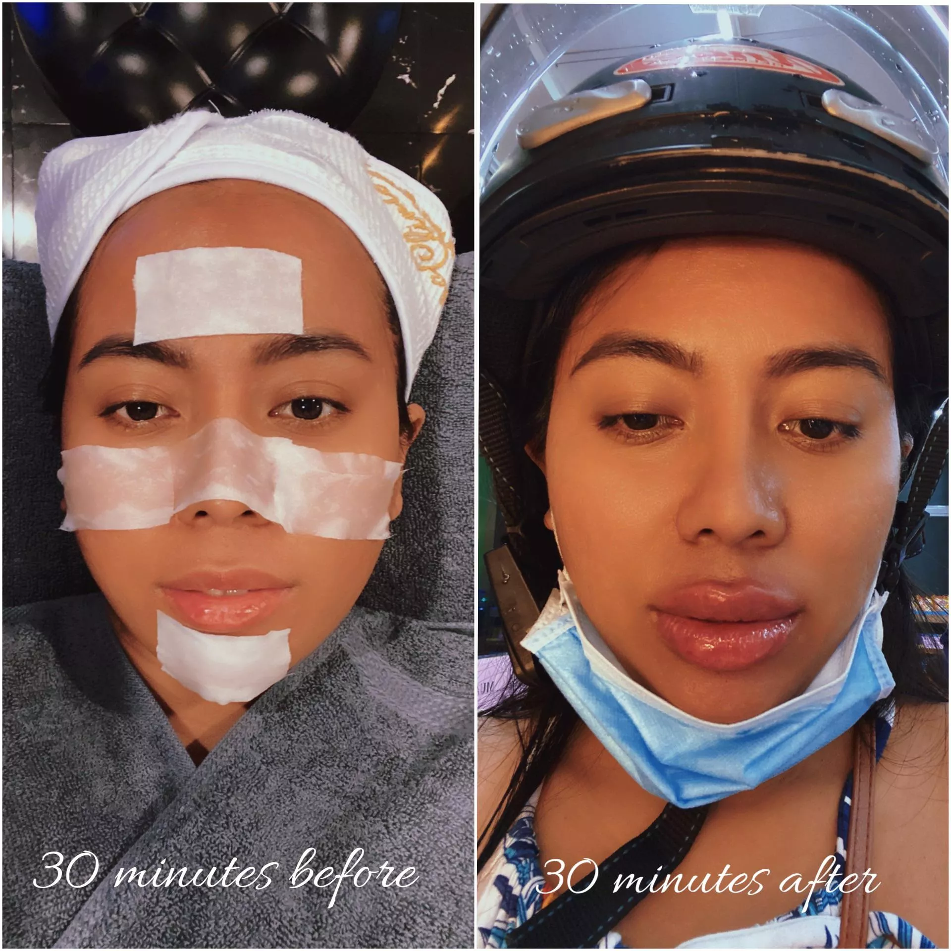 I just had a lip filler done sponsored by a generous, hot daddy! I’m gonna take lots of photos and videos all dolled up, but I just wanna share this now (I’m that excited!) How do my new bimbo lips look? I had a facial before the procedure (not the k