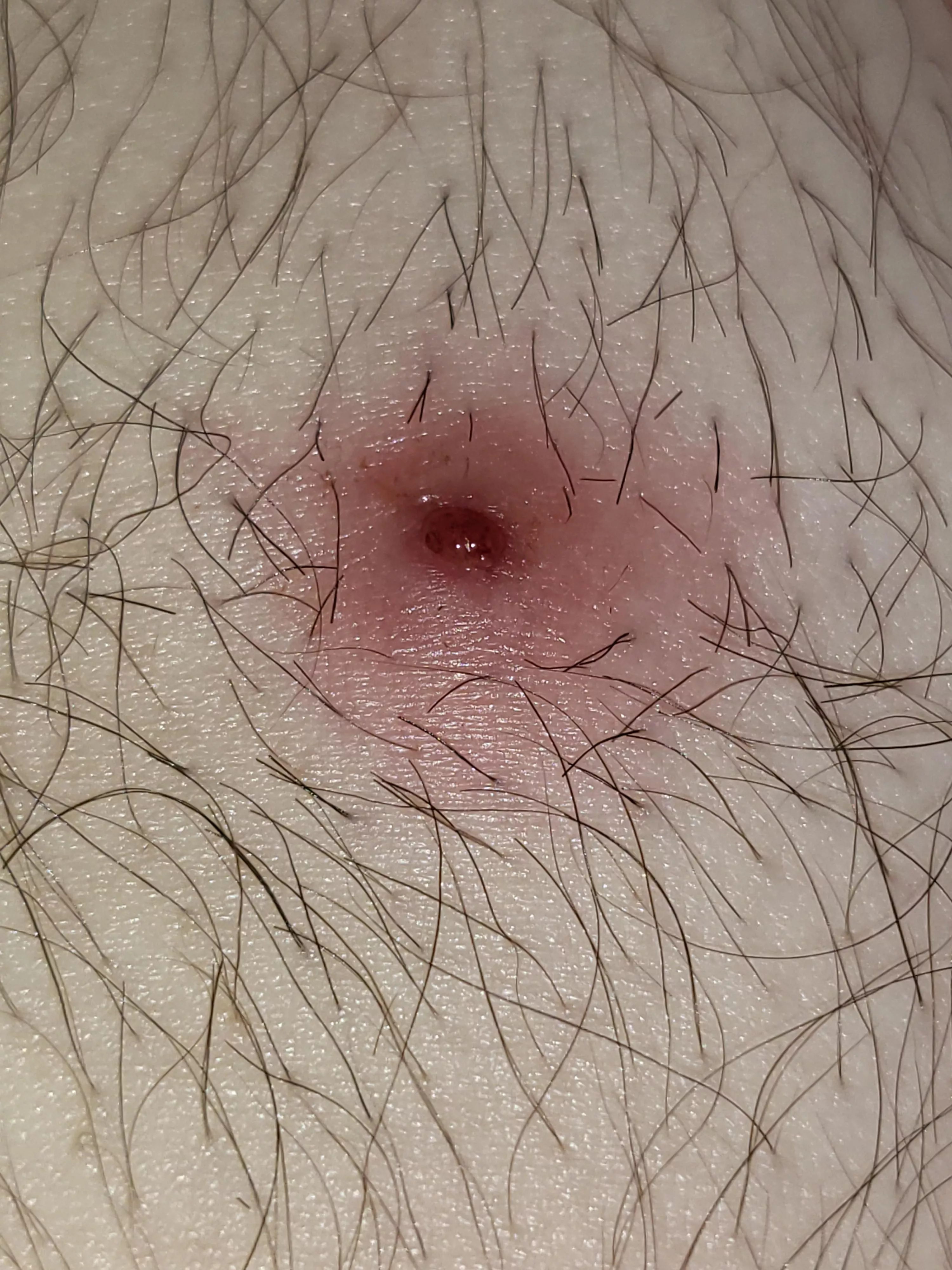 Cyst finally drained while in the shower without my seeming to have to do anything. Have questions.
