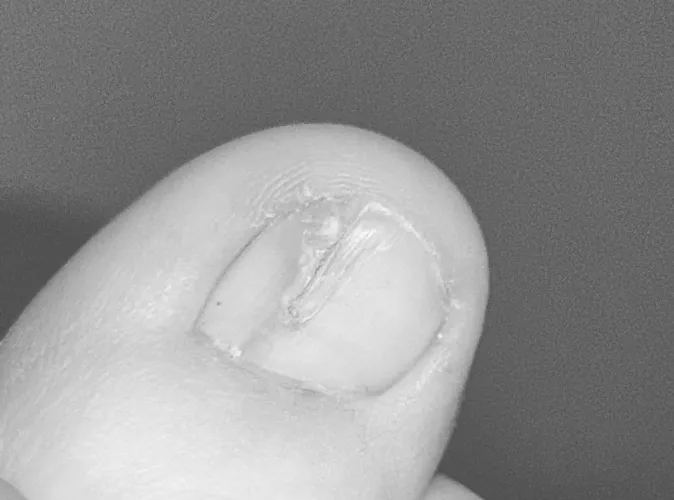 Broken toenail/ damaged toenail