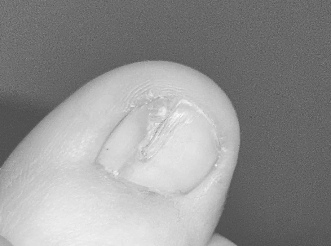 Broken toenail/ damaged toenail