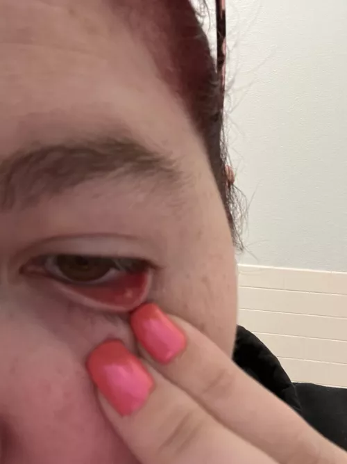 Forbidden pop in my left eye. Not sure what it is. It’s slightly larger today but not much so I’m giving it a couple of days to see what happens before I go to the doctor.