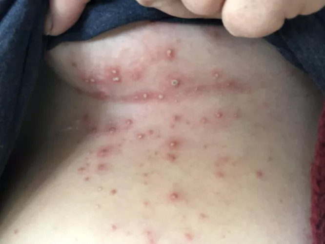 A heat rash that I let get a little out of control