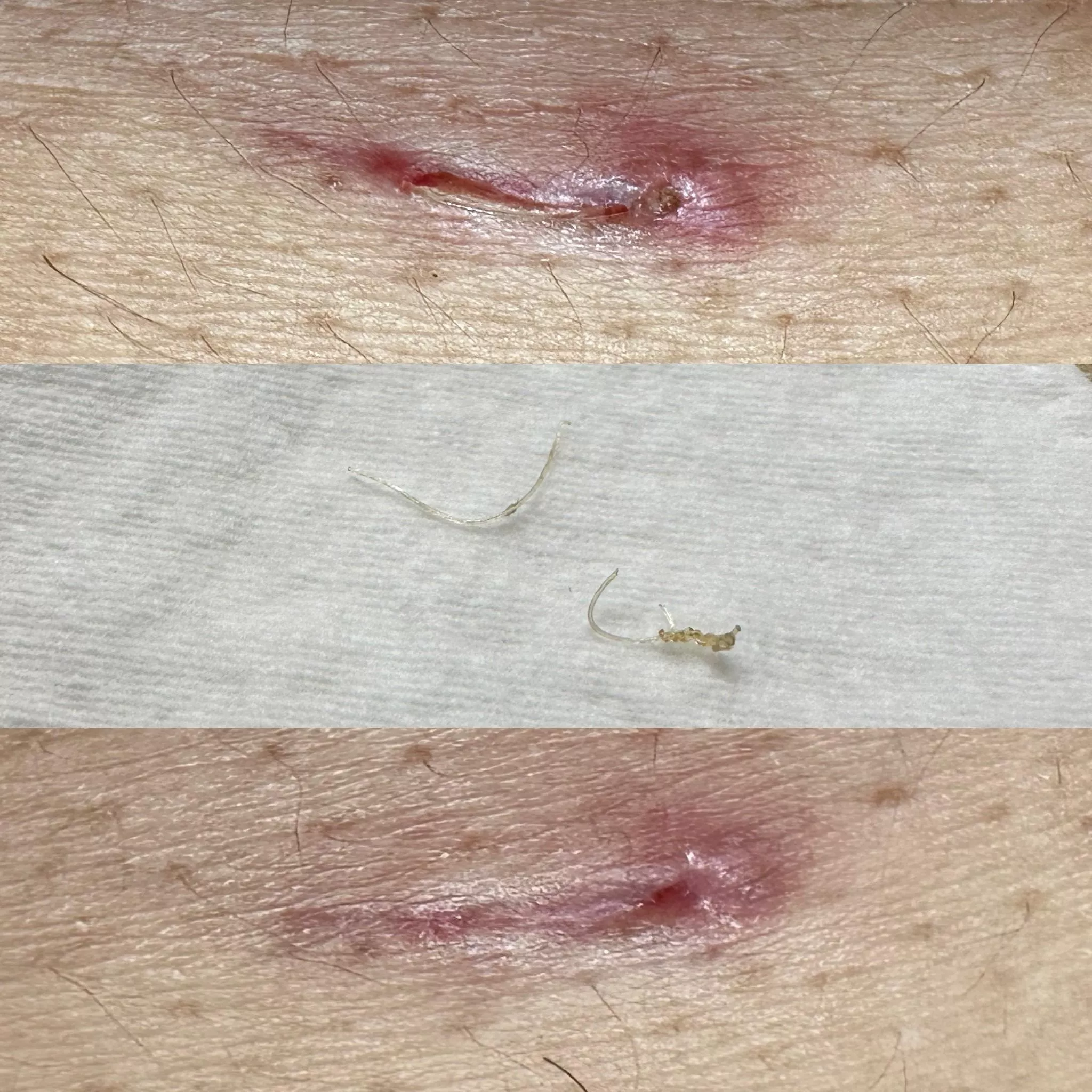 Leftover dissolvable stitch from surgery removed, to much relief.