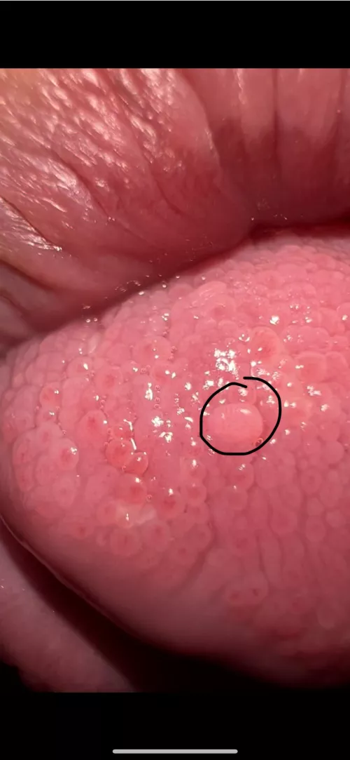 What is that my tongue? Wart or bump?